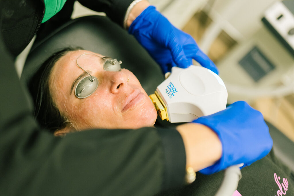 Why Winter is the Best Time for Laser Treatments in Fort Worth