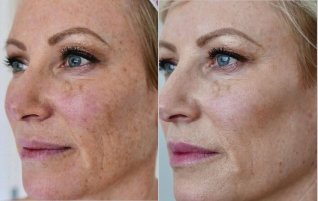 halo-laser-skin-resurfacing-249-left-oblique-detail
