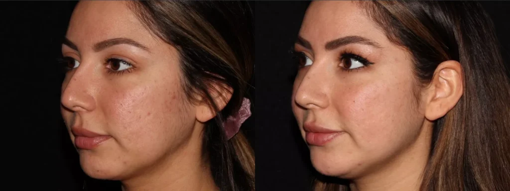 profractional-laser-resurfacing-37-left-side-detail