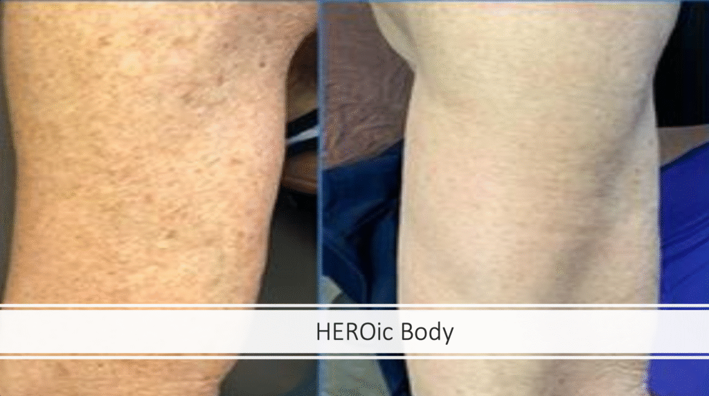 BBL HEROic before and after showing reduced age spots and skin redness on the face